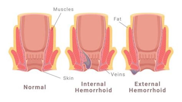Are external hemorrhoid painful?