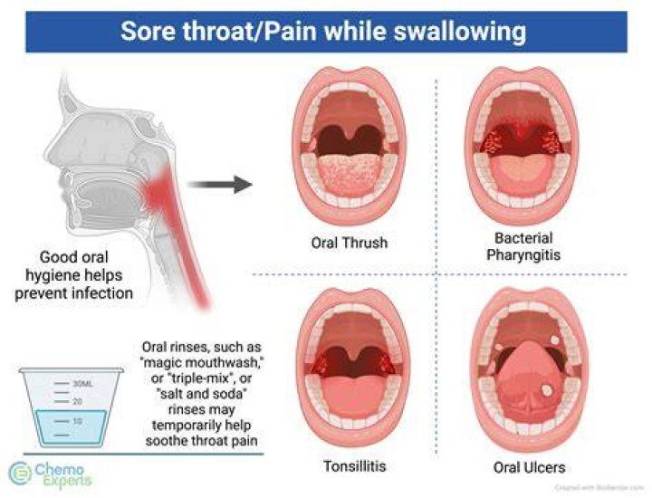 Can mouthwash cause sore throat?