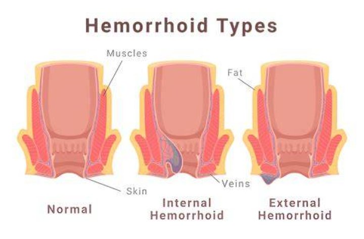 Did my hemorrhoid pop?