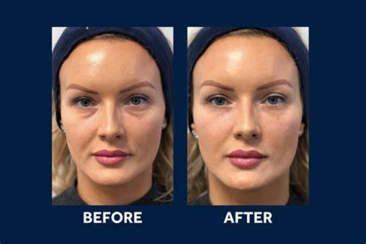 Do tear trough fillers work for dark circles?