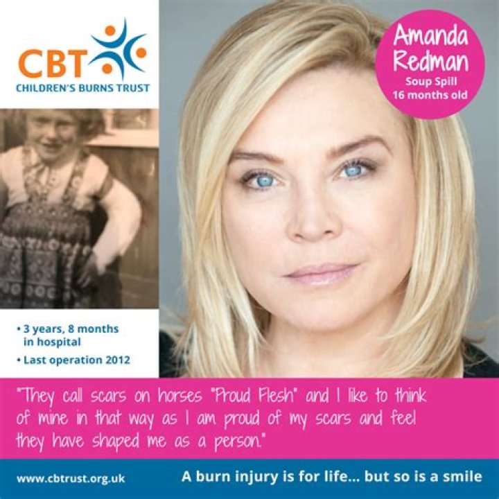 Does amanda redman have a scar on her arm?