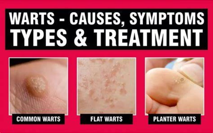 How do you get warts?