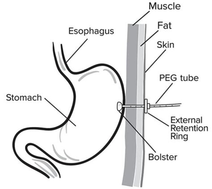 Is a peg tube a gastrostomy?