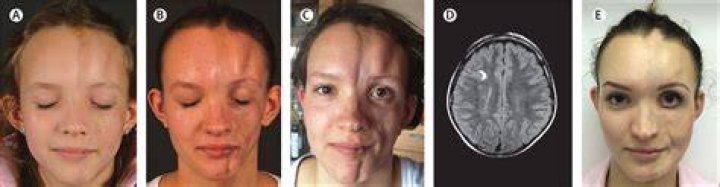 Is facial hemiatrophy hereditary?