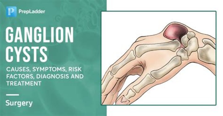Is ganglion cyst cancerous?