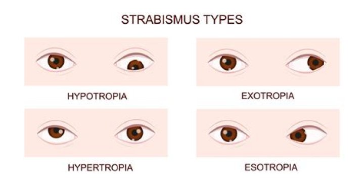 Is strabismus and tropia?