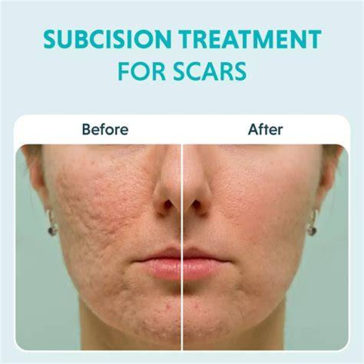 Is subcision good for acne scars?