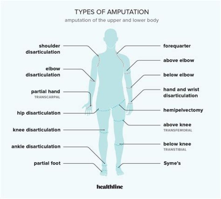 What are the types of amputation?