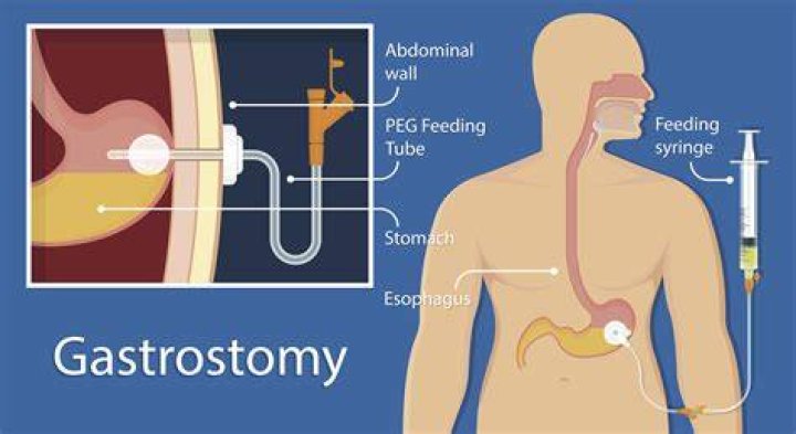 Where is gastrostomy tube placed?