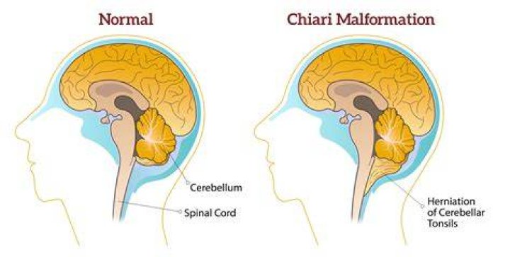 Which chiari malformation is worse?