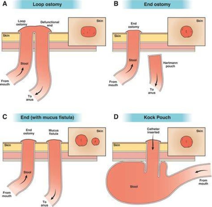 Why does my stoma hurt?